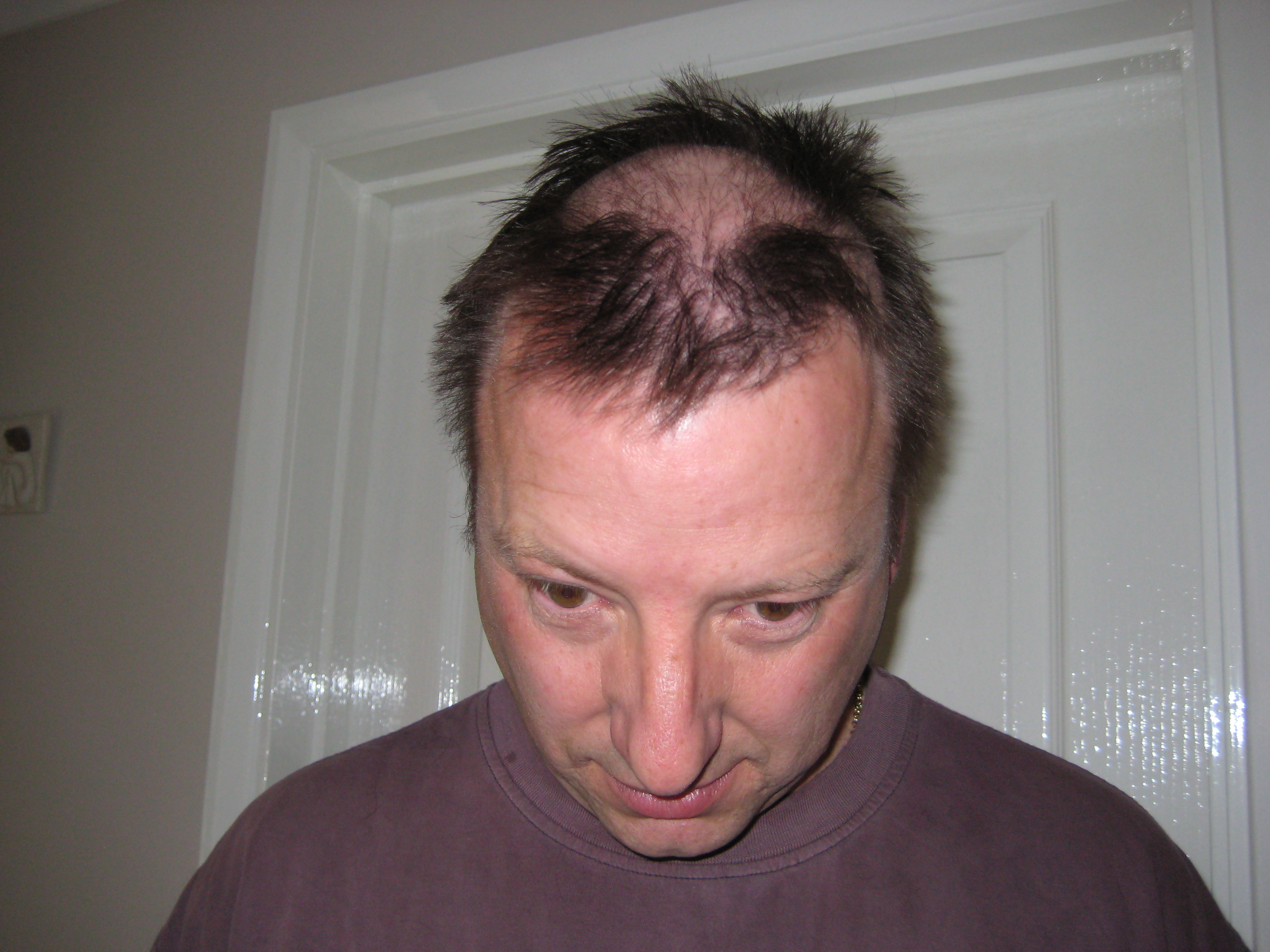 Hair Loss Andrew Tokelys Breast Cancer Blog